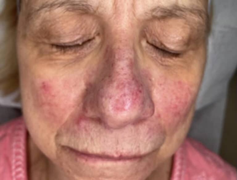 BBL (treating Rosacea) - Affiliated Troy Dermatologists
