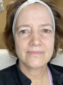 BBL (treating Rosacea) - Affiliated Troy Dermatologists