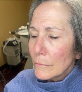 BBL (treating Rosacea) - Affiliated Troy Dermatologists