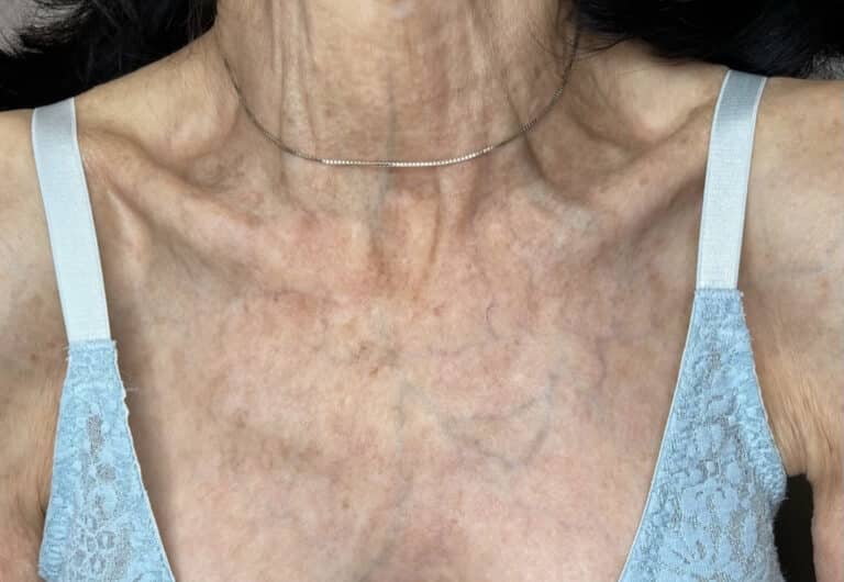 Erbium Fractional Laser (treating Seborrheic Keratosis) Affiliated