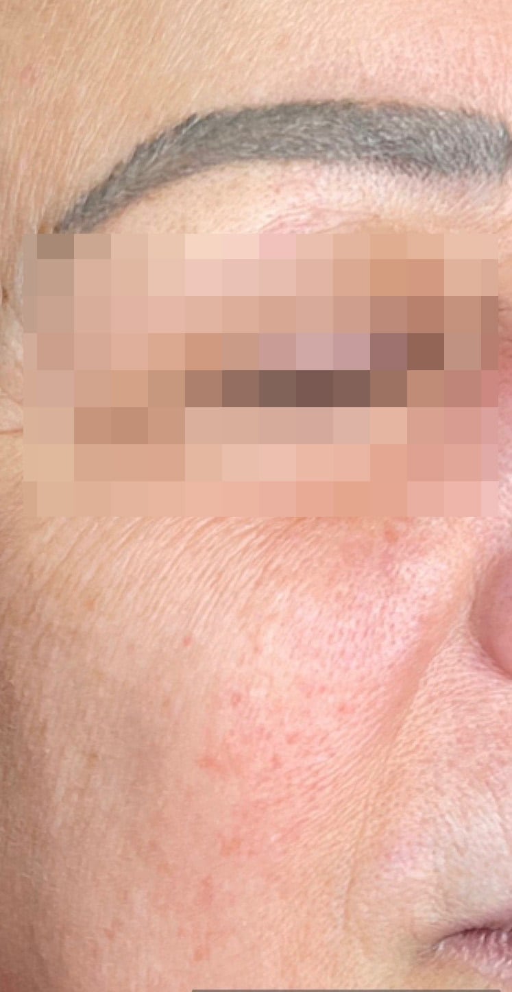 After Image: BBL Treating Port Wine Stain - right-front-oblique