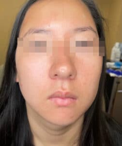After Image: BBL Treating Acne