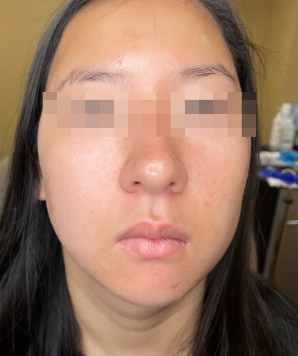 After Image: BBL Treating Acne - front