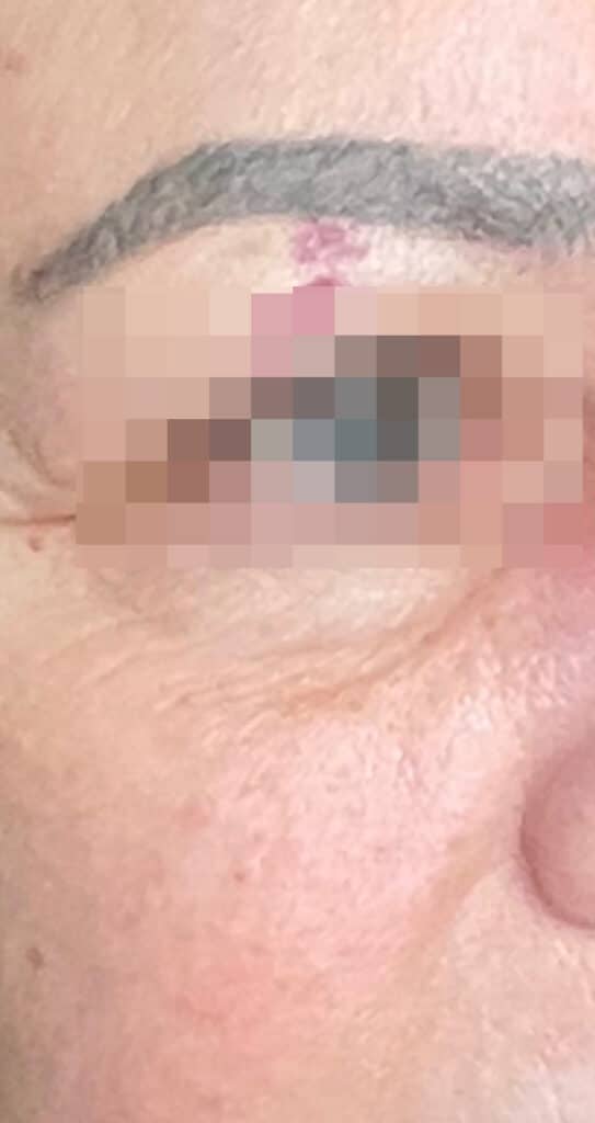 Before Image: BBL Treating Port Wine Stain - right-front-oblique