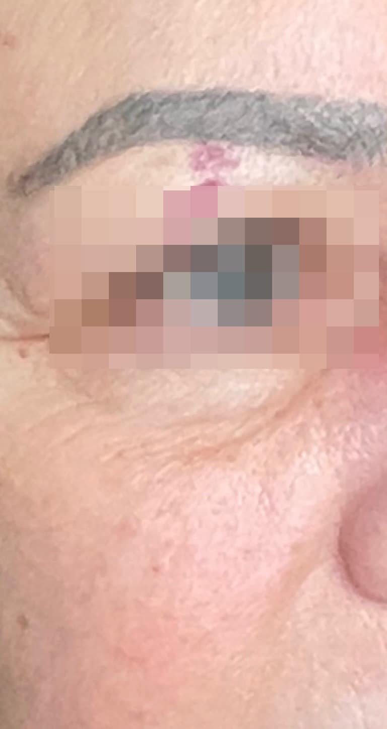 Before Image: BBL Treating Port Wine Stain - right-front-oblique