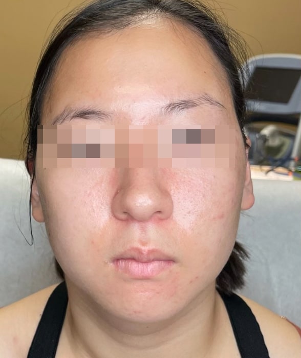 Before Image: BBL Treating Acne - front