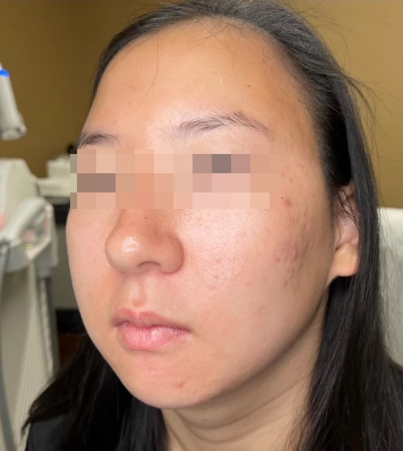 After Image: BBL Treating Acne - left-front-oblique