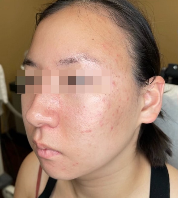 Before Image: BBL Treating Acne - left-front-oblique