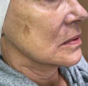 Before Image: BBL + Halo Treating Photoaging
