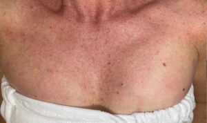 Before Image: BBL + Halo Treating Photoaging – Chest