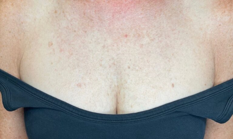 After Image: BBL + Halo Treating Photoaging – Chest - front