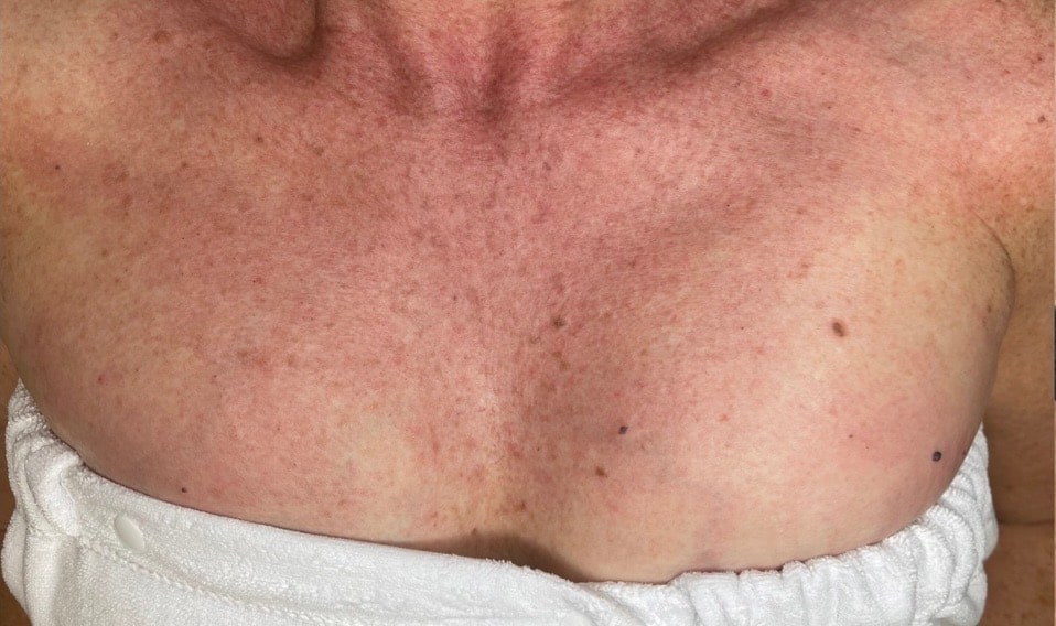 Before Image: BBL + Halo Treating Photoaging – Chest - front
