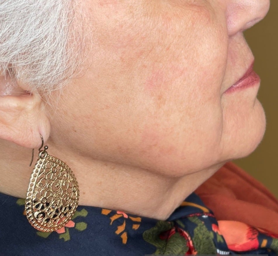 After Image: BBL + Halo Treating Photoaging - right-front-oblique
