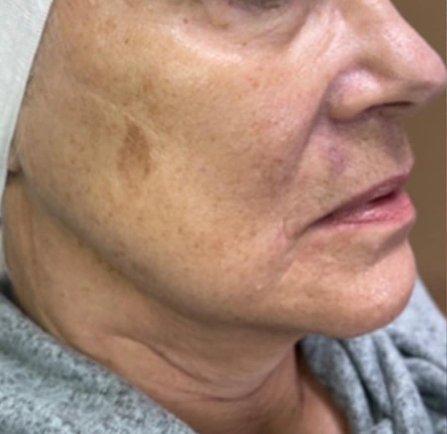 Before Image: BBL + Halo Treating Photoaging - right-front-oblique