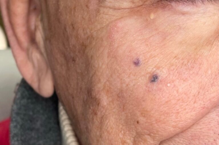 Before Image: BBL Treating Hemangioma - right-front-oblique