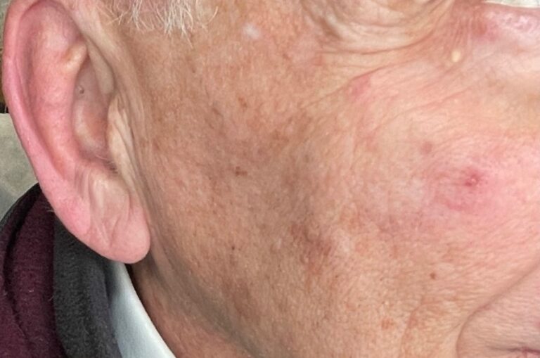 After Image: BBL Treating Hemangioma - right-front-oblique