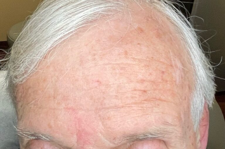 After Image: BBL Treating Hemangioma - front