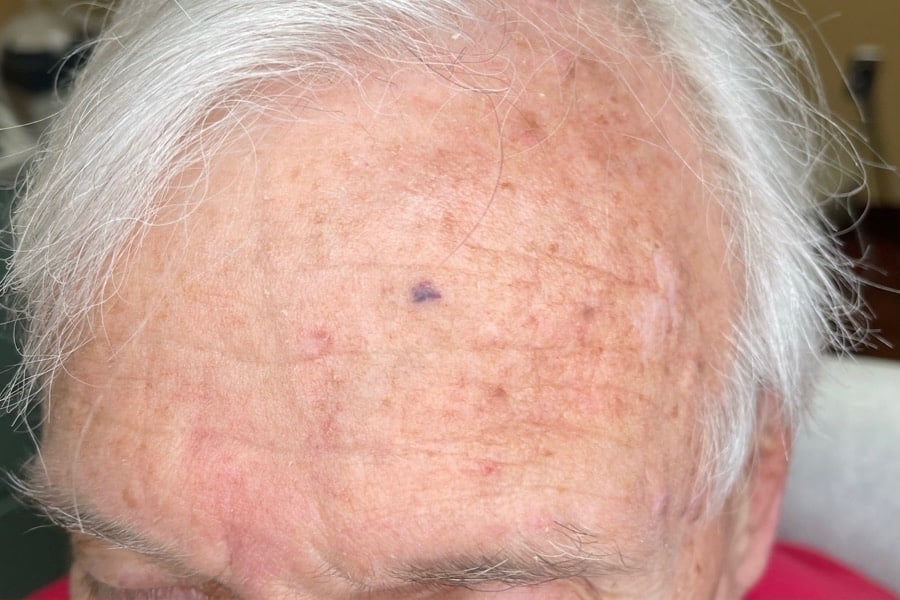 Before Image: BBL Treating Hemangioma - front