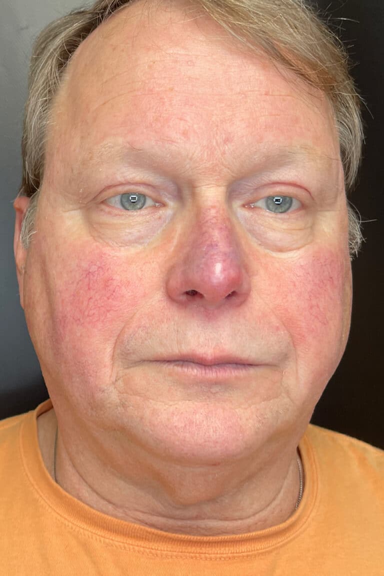 Before Image: BBL Treating Rosacea - front