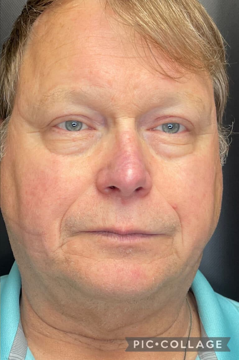 After Image: BBL Treating Rosacea - front