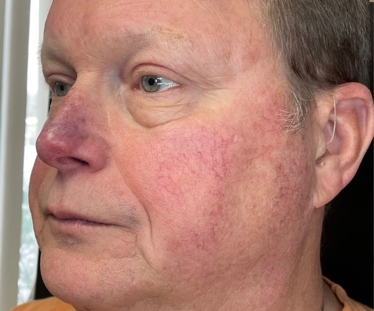 Before Image: BBL Treating Rosacea - left-front-oblique