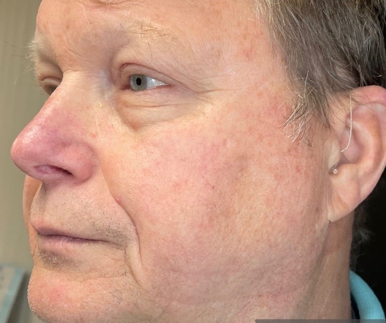 After Image: BBL Treating Rosacea - left-front-oblique