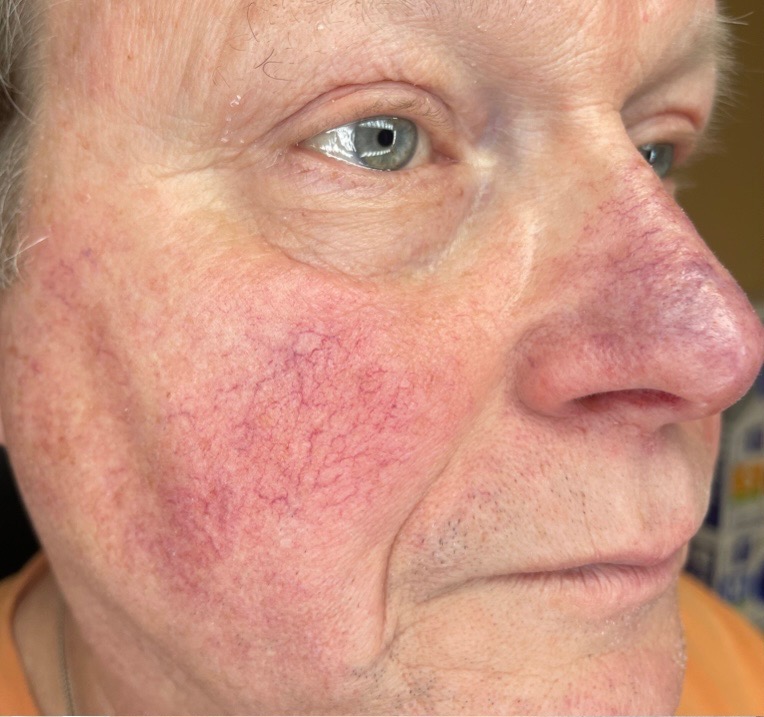 Before Image: BBL Treating Rosacea - right-front-oblique