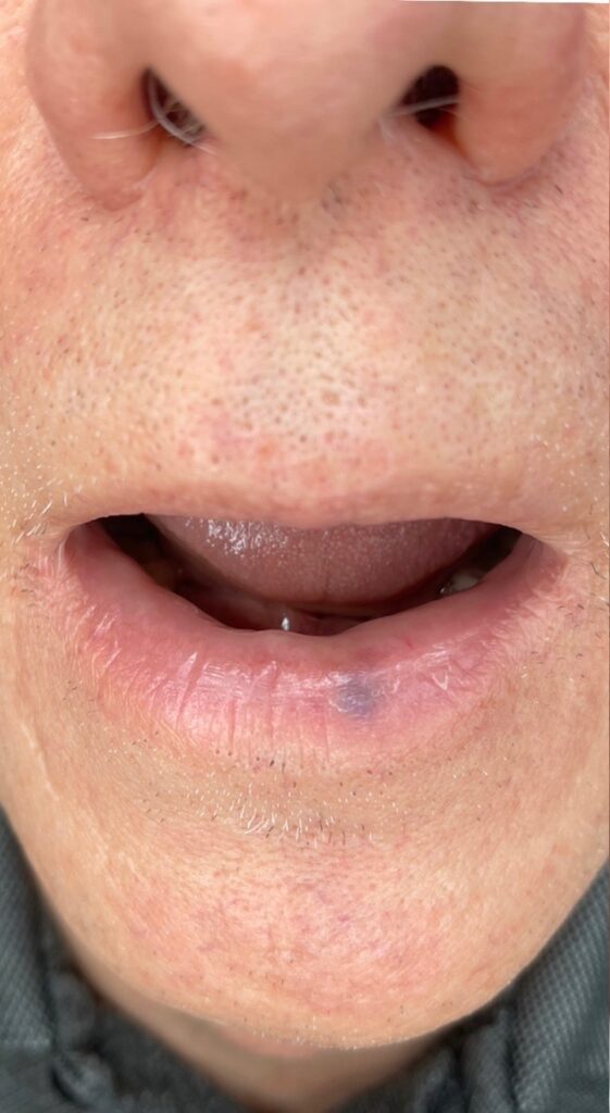 Before Image: BBL Treating Venous Lake - front