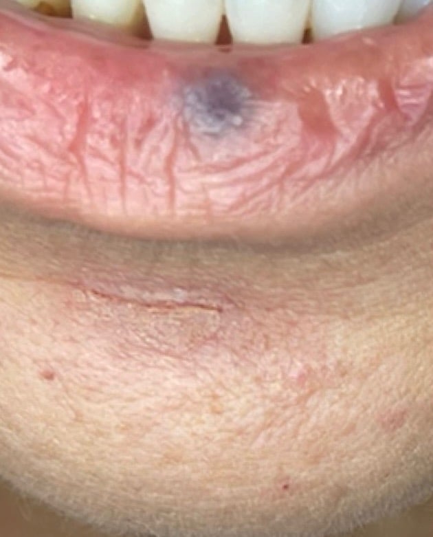 Before Image: BBL Treating Venous Lake - front