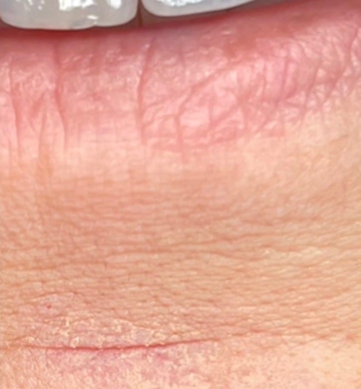 After Image: BBL Treating Venous Lake - front