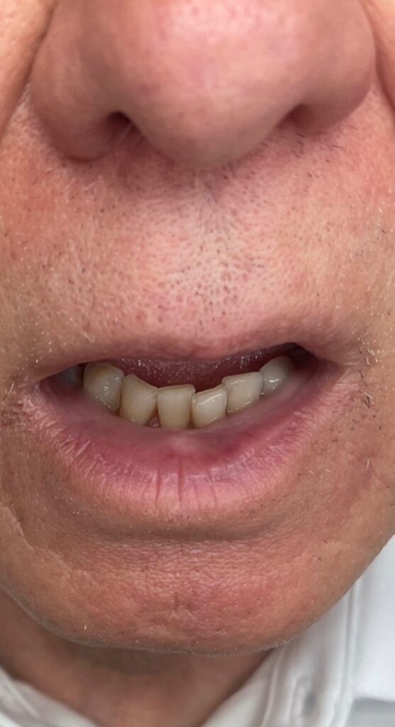 After Image: BBL Treating Venous Lake - front