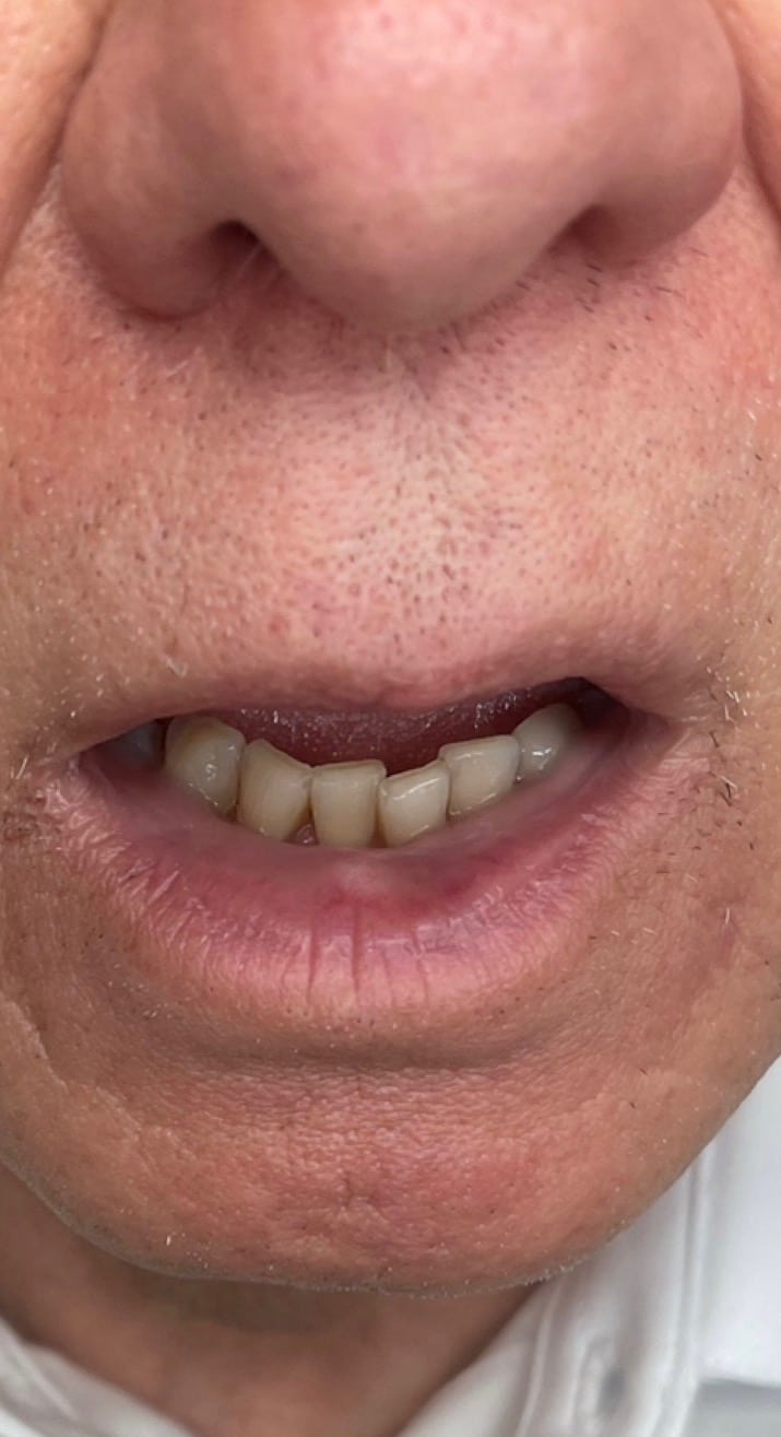 After Image: BBL Treating Venous Lake - front