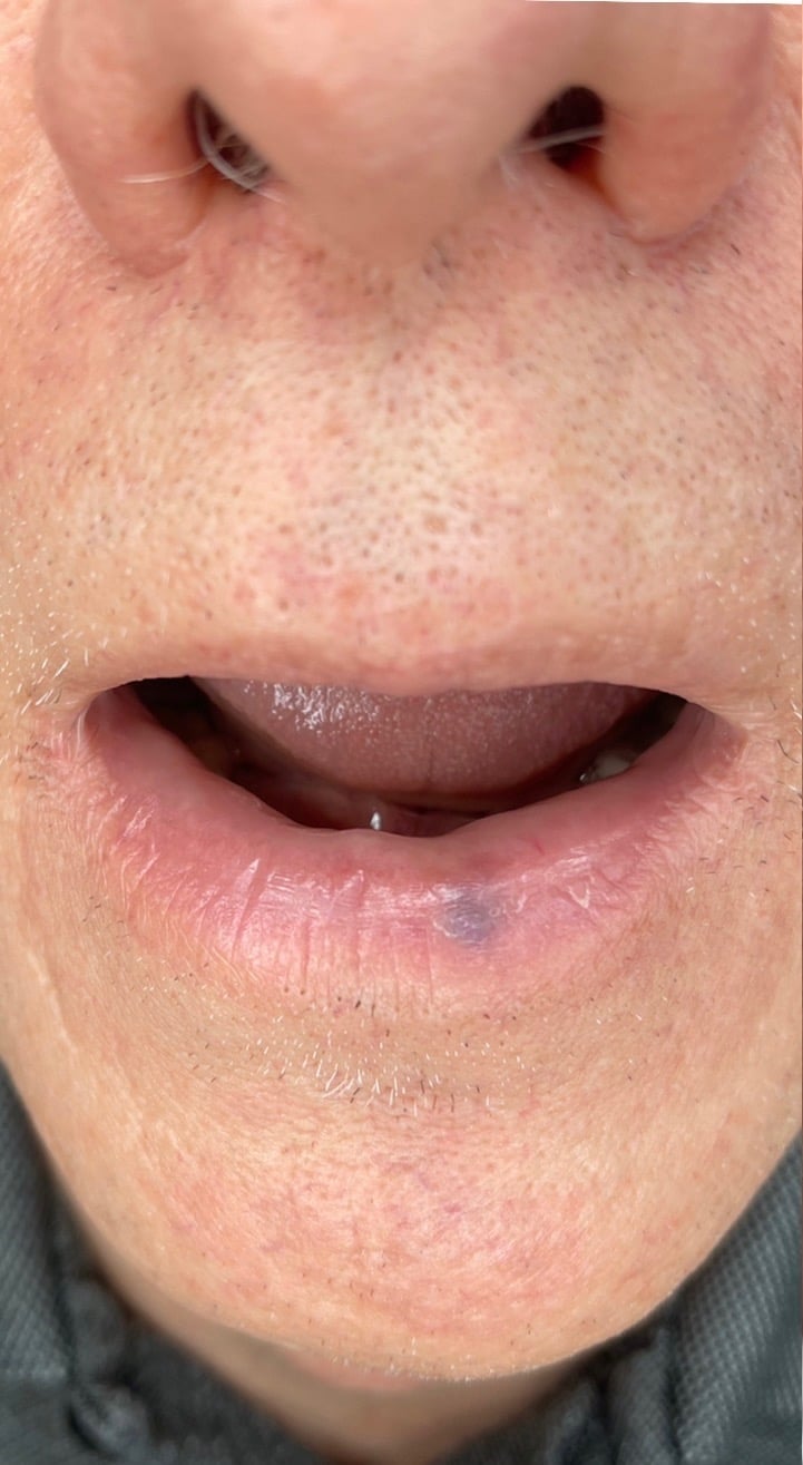 Before Image: BBL Treating Venous Lake - front