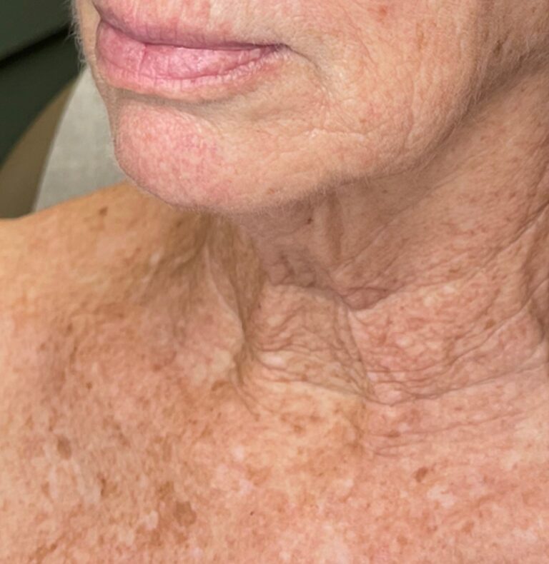 Before Image: BBL+Halo Photoaging Treatment - front