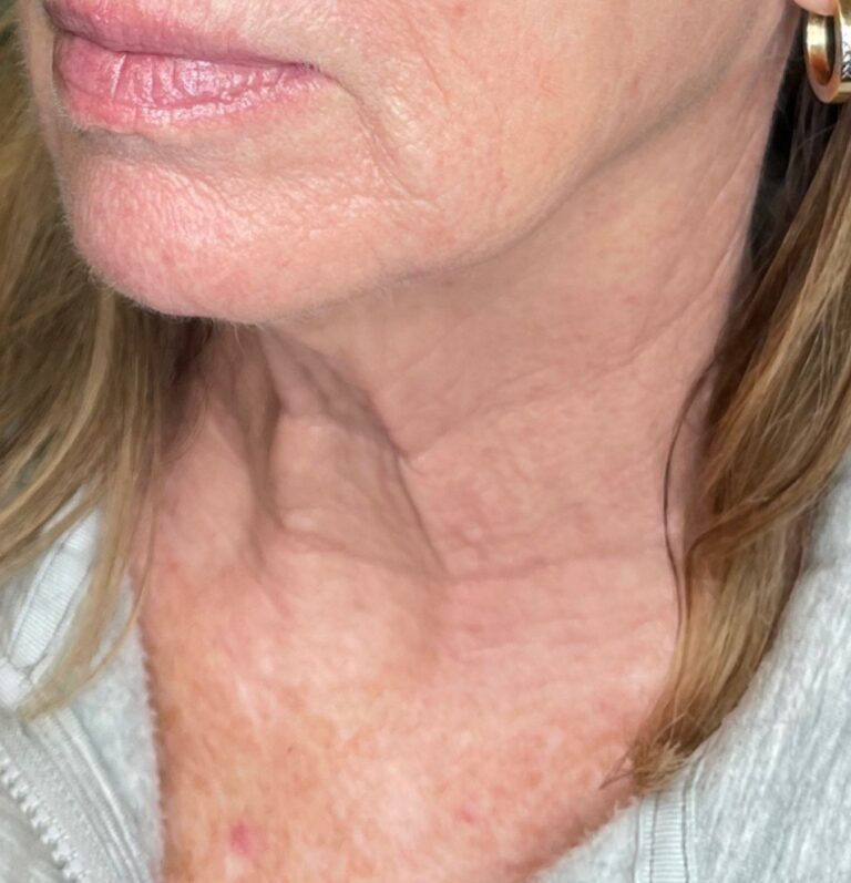 After Image: BBL+Halo Photoaging Treatment - front