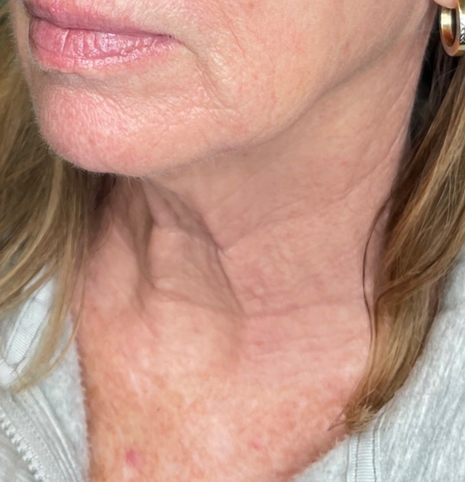 After Image: BBL+Halo Photoaging Treatment - front