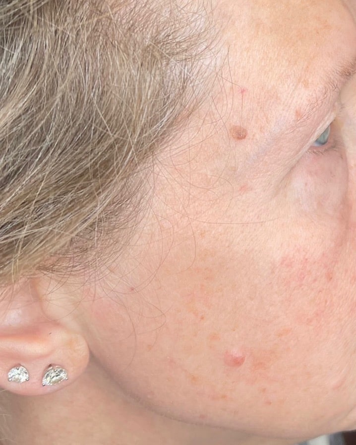 Before Image: Fractional Laser Treating Seborrheic Keratosis - front