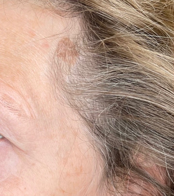 Before Image: Fractional Laser Treating Seborrheic Keratosis - left-front-oblique