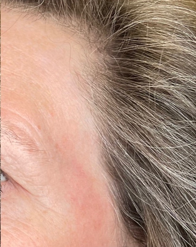 After Image: Fractional Laser Treating Seborrheic Keratosis - left-front-oblique