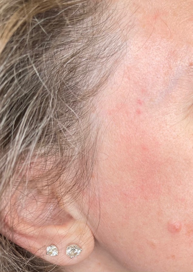 After Image: Fractional Laser Treating Seborrheic Keratosis - front