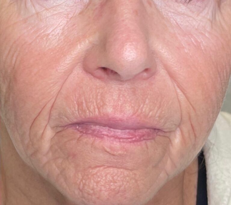 After Image: Halo Treating Textured and Lax Skin - front