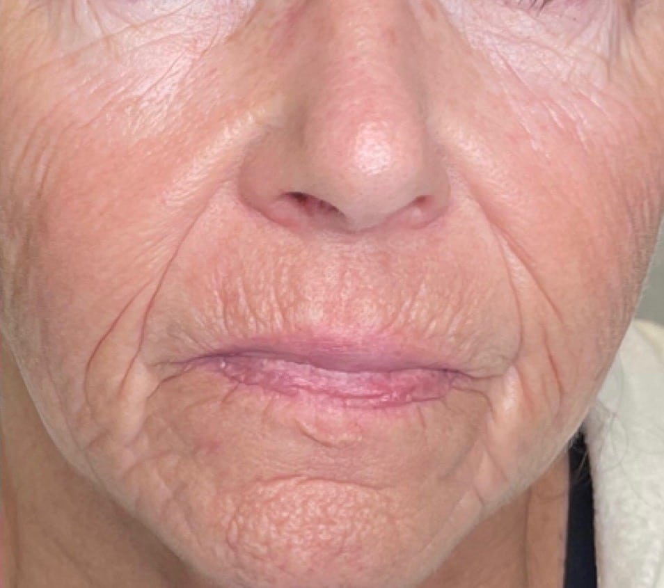 After Image: Halo Treating Textured and Lax Skin - front