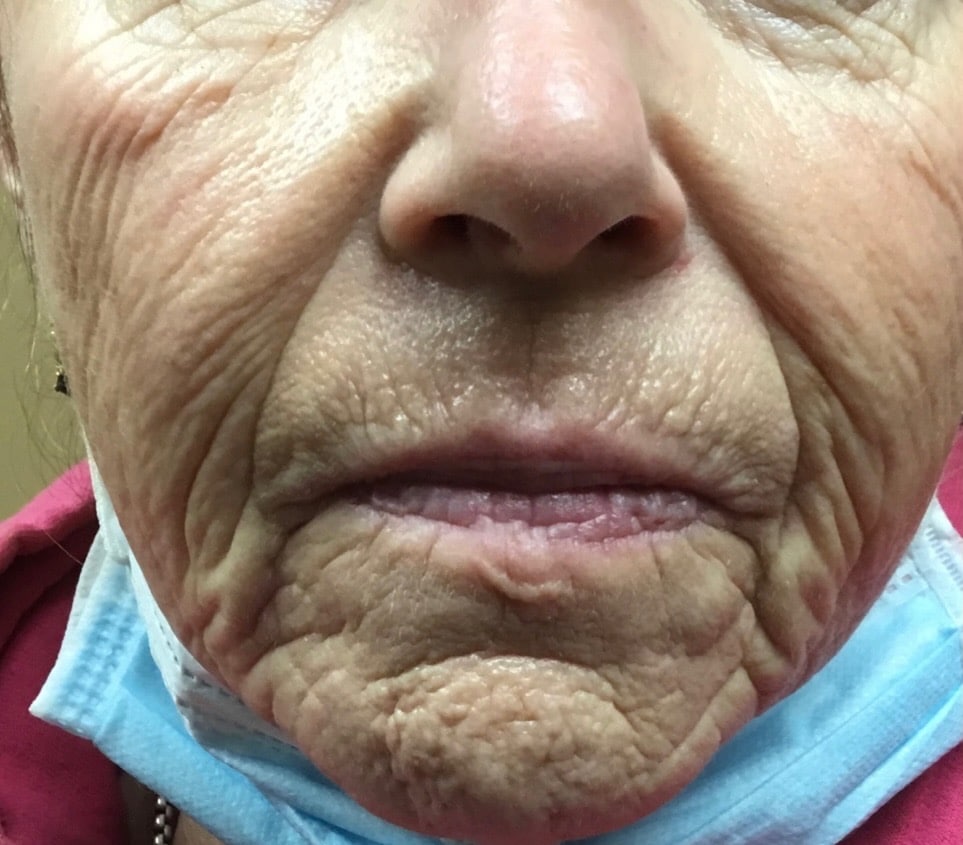 Before Image: Halo Treating Textured and Lax Skin - front